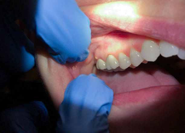 Best Emergency Dental Care for Sports Injuries in South Charleston, WV